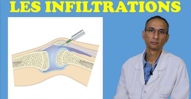 LE TRAITEMENT DES DOULEURS ARTICULAIRES PAR LES INFILTRATIONS : علاج آلام المفاصل بالحقن الموضعية