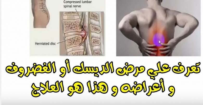 كيفية علاج الغضروف الديسك  و آلام المفاصل بالأعشاب