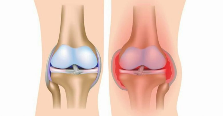 اليكي .. اقوي طريقة لعلاج المفاصل بطرق كبيعية | علاج المفاصل بالاعشاب