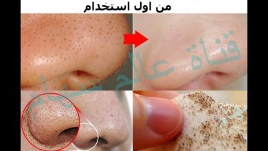 حصريا ب 3 دقائق ضعي هذه الخلطة على الرؤوس السوداء لتخرج وتزال بسرعة بدون عصرها اولمسها