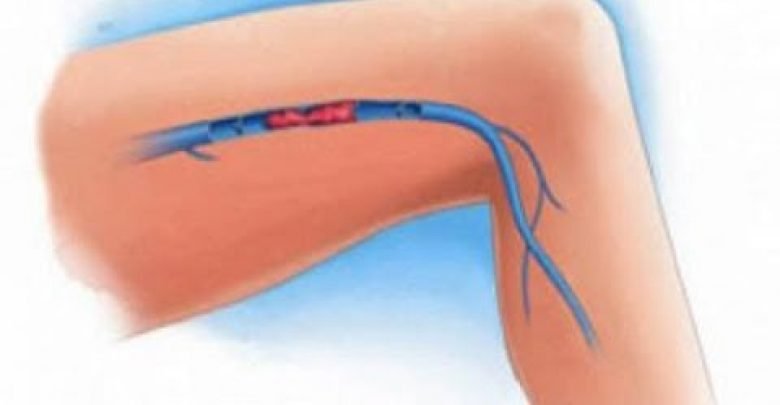 الجلطة في الساق : الأعراض والوقاية ( من الضروري أن تعرفوها)…