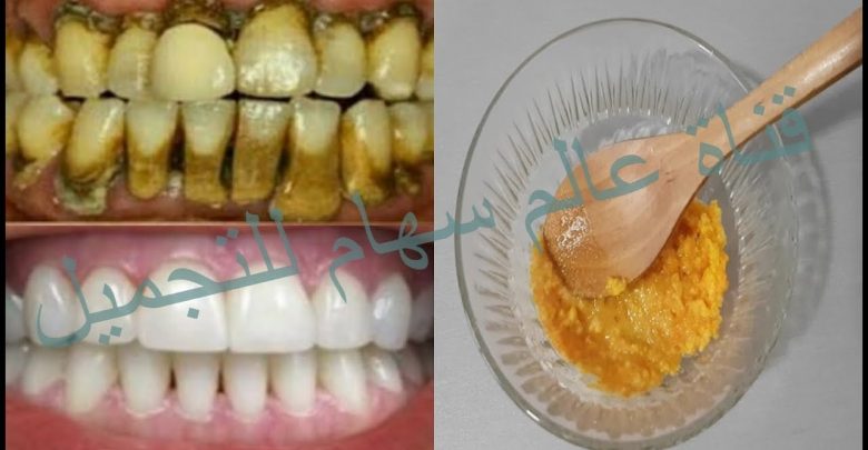 افركي به اسنانك دقيقتين ترجع بيضاء كحبات اللؤلؤويذيب الجيرالمتراكم بها لسنوات دون طبيب وبلا تكاليف