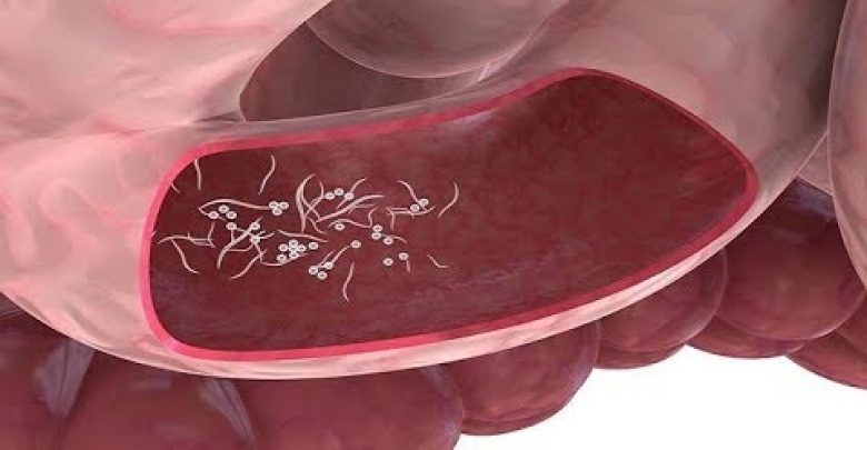 اقضوا بثلاثة أعشاب فقط على الطفيليات والديدان المعوية وبيوضها