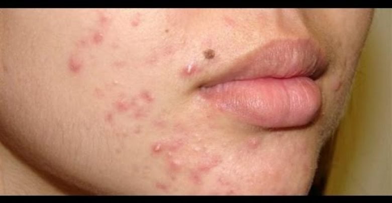 3 طرق بسيط للتخلص من حبّ الشباب “acne”