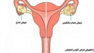 أسهل طرق لعلاج تكيس المبيض في المنزل