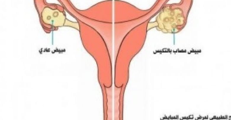 أسهل طرق لعلاج تكيس المبيض في المنزل