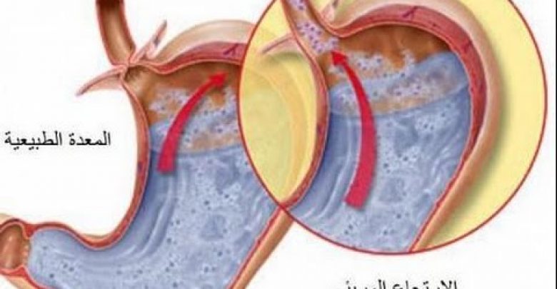 تعرف علي أسباب ارتجاع المريء وكيفية علاجه