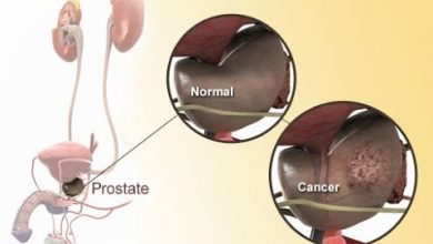 كيفية الوقاية من سرطان البروستاتا