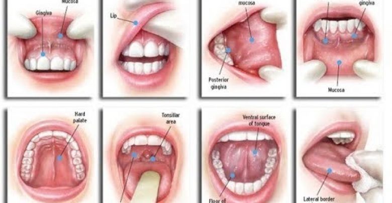 ٨ علامات لاكتشاف سرطان الفم مبكراً
