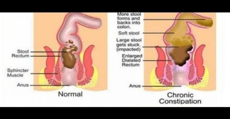 الامساك المزمن اسبابه وعلاجه طبيعيا