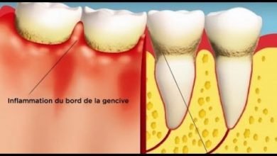 التهاب اللثة المرض الصامت   إليك حيلا للقضاء عليه