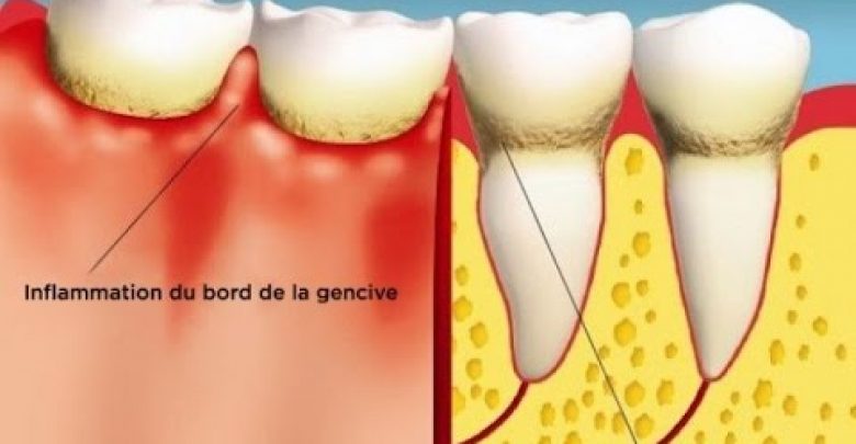 التهاب اللثة المرض الصامت   إليك حيلا للقضاء عليه