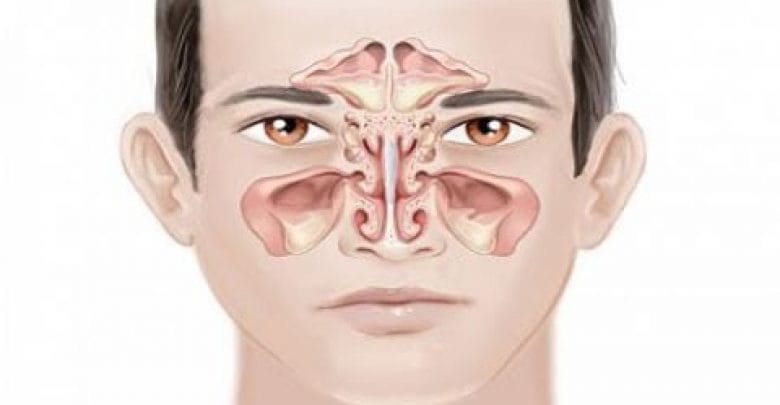 يلا خبر  | التهابات الجيوب الأنفية أنواعها وطرق علاجها