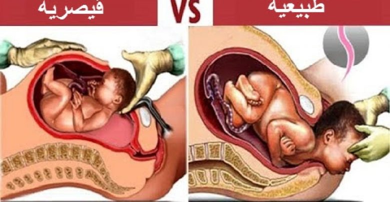 10 أشياء لم تكن تعرفها , عن الولادة الطبييعة و القيصرية .. !!