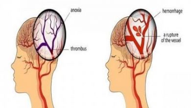 يلا خبر  | 6 إشارات تنذركم بأن جلطة دماغية على وشك الحدوث