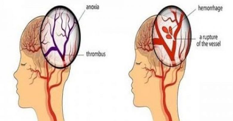 يلا خبر  | 6 إشارات تنذركم بأن جلطة دماغية على وشك الحدوث