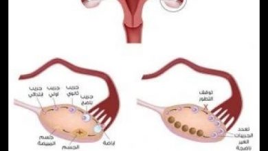 يلا خبر  | علاج تكيس المبايض بوصفات طبيعية صحية