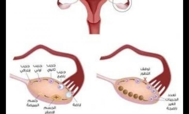 يلا خبر  | علاج تكيس المبايض بوصفات طبيعية صحية