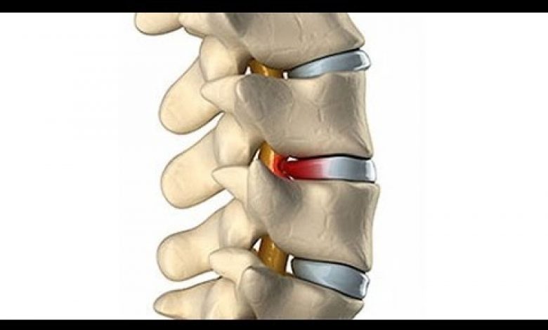 يلا خبر  | أعراض ديسك الظهر وطرق العلاج
